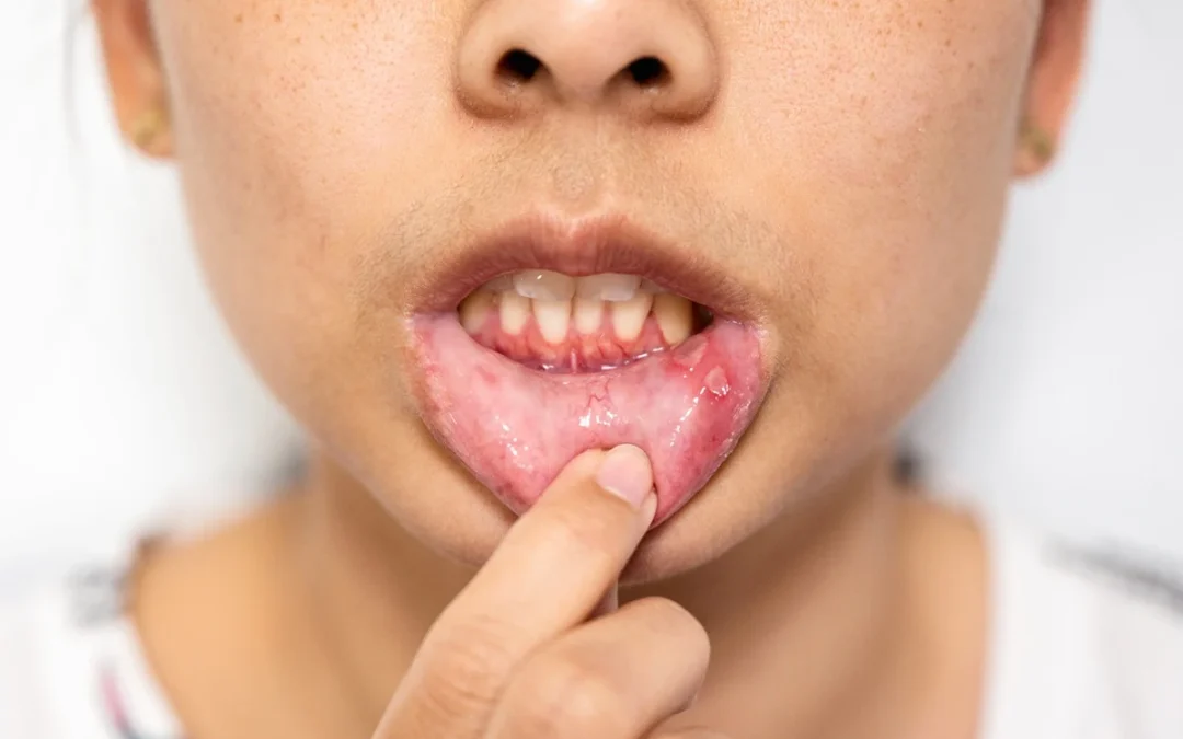 Why Are My Child’s Gums Red and Swollen?