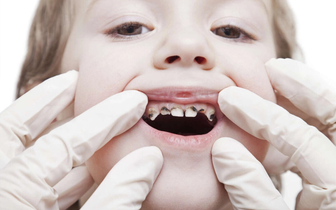 Take Away Bottle Tooth Decay